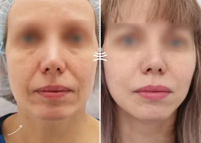 Нитевой лифтинг - подтяжка лица 3D мезонитями в клинике Медицина для Вас на  Красносельской