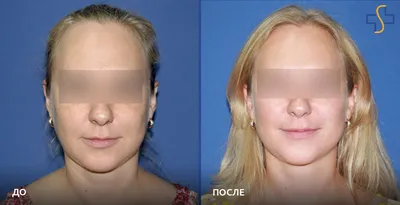 Мезонити цена процедуры - подтяжка лица в Москве | ☎
