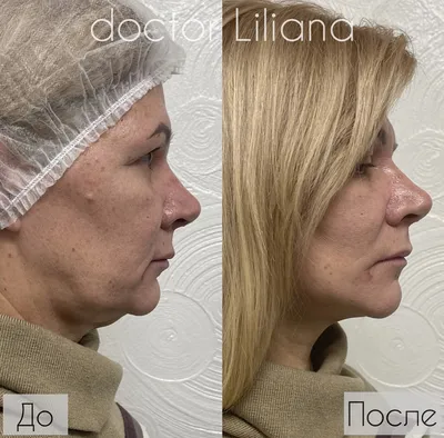 Мезонити. Как они работают и чего от них ждать — vzbeauty.ru