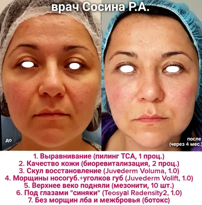 Beauty Medical Поставки косметики для салонов красоты - 🔥Магия мезонитей.  Как Вам результат!? Мезонити Molding press-Cog (литые насечки) 19Gx100mm -  рассасывающиеся, прочные, умеренно эластичные (PDO). ⠀ ☝️Могут  использоваться для лифтинга контуров ...