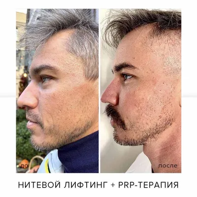 Подтяжка лица нитями Аптос: какие зоны и проблемы корректируют мезонити –  информационные материалы от специалистов клиники