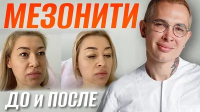 Фоторепортаж: нитевой лифтинг лица