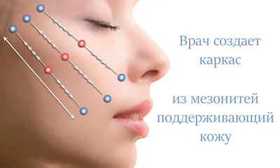 Мезонити для подтяжки лица - все о процедуре, плюсы и минусы | Сеть клиник  ЛИНЛАЙН