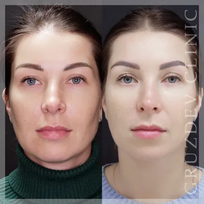 3D мезонити – фотографии до и после