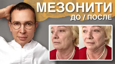 МЕЗОНИТИ ДО и ПОСЛЕ/ лечение возрастных изменений - YouTube