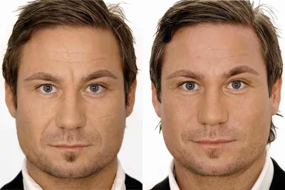 3D мезонити – фотографии до и после