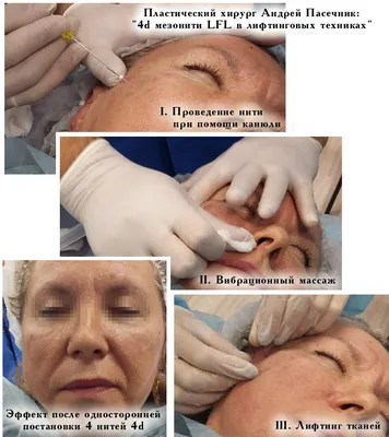 Сделать тредлифтинг мезонитями | Цена, отзывы, до и после