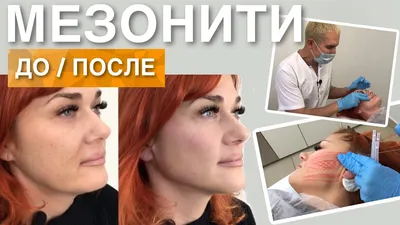 Что такое мезонити | Клиника эстетической медицины “Elevans”