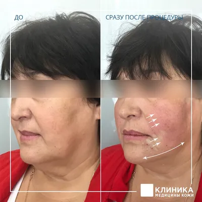 Нити Аптос для подтяжки лица: цена нитевого лифтинга Aptos в СПб