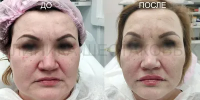 Мезонити / Нитевой лифтинг / Клиника косметологии \"Шестаковых\"