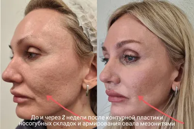 Радиес и Мезонити. Как изменилось лицо за 3 года — vzbeauty.ru