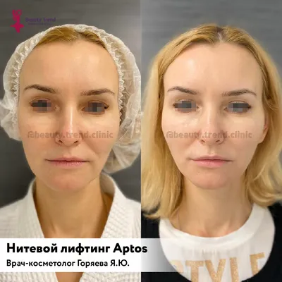 Работа - Нитевой лифтинг (мезонити), Горяева