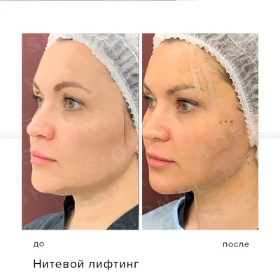 Результат нитевого лифтинга мезонитями Lead Fine Lift