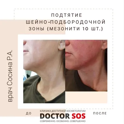 Нити: мезонити гладкие и лифтинговые с шипами | Клиника Инновационной  Косметологии DoctorSOS