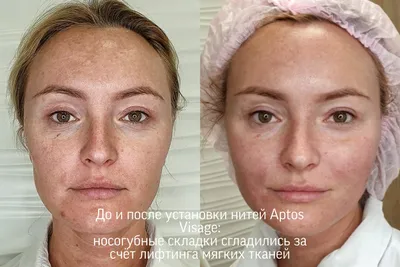 Нити Аптос, нитевой лифтинг лица и тела нитями Aptos в Ижевске