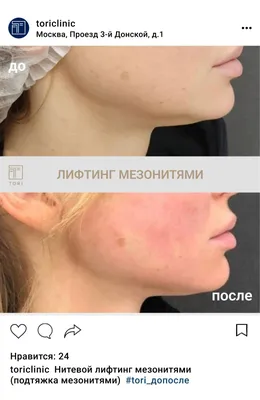 Нитевой лифтинг мезонитями, цена в Москве