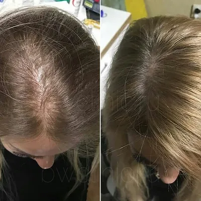 Мезотерапия для волос фото до и после фотографии