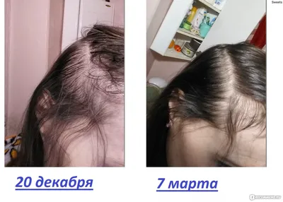 Мезотерапия волос в Москве по цене от 8835 руб. в клинике Beauty Trend