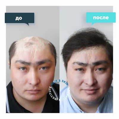 Expert Aesthet - ⏹️МЕЗОТЕРАПИЯ ДЛЯ ВОЛОС⏹️ ⠀⠀⠀⠀⠀⠀⠀⠀⠀⠀⠀⠀⠀⠀ Попробуйте  мезотерапию для волос и кожи головы. Это одна из самых востребованных на  сегодня салонных процедур по уходу за уставшими и ломкими волосами,  склонными к