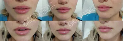 Увеличение и коррекция формы губ гиалуроновой кислотой в Jolly Clinic