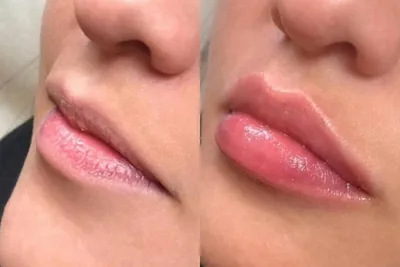 Увеличение губ: техники процедуры, последствия и фото результата | Клиника  ГАЛАКТИКА | Дзен