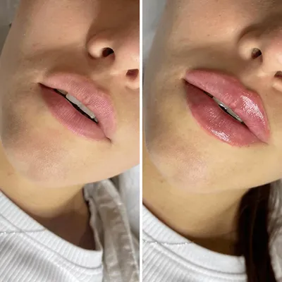 Косметолог Ольга Якусик - Мечтаете об идеальных губах, но не можете  решиться на контурную пластику? 🤩Есть решение - мезотерапия губ! С ее  помощью можно создать эффект пышных губ или скорректировать их форму.
