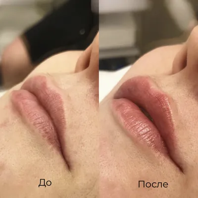 КОСМЕТОЛОГ | МАХАЧКАЛА-МОСКВА | ОБУЧЕНИЕ🇷🇺 on Instagram | Lip fillers,  Lip fillers juvederm, Botox lips
