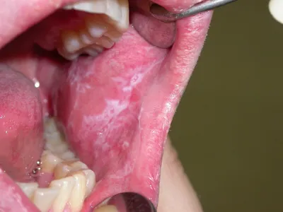 МЯГКАЯ ЛЕЙКОПЛАКИЯ: ЧТО ЭТО ТАКОЕ? ⠀⠀⠀⠀⠀⠀⠀⠀⠀⠀⠀⠀⠀⠀⠀⠀⠀⠀⠀⠀⠀⠀⠀⠀⠀⠀⠀ Это  результат хронической травмы слизистой оболочки полости рта… | Instagram
