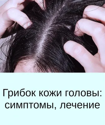Грибковые болезни на гладкой коже и на волосистой части головы
