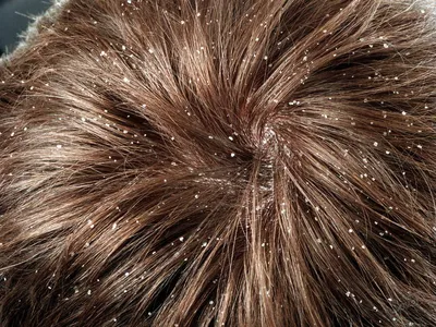 Системная терапия микозов волосистых участков кожи: возможности адъювантных  препаратов uMEDp