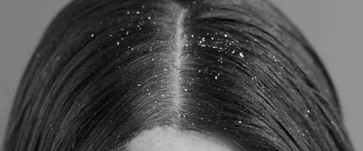 Грибок кожи головы: 6 натуральных средств для лечения | Кожа головы, Кожа,  Натуральные средства