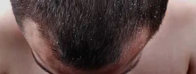 Взорвать черных волос азиатов с проблемами здоровья волос и кожи головы на  формы Стоковое Изображение - изображение насчитывающей грибок, женщина:  188364813