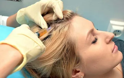 Грибок кожи головы: симптомы (ФОТО), эффективные шампуни и мази для лечения