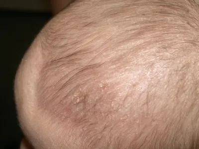 Себорейный дерматит кожи волосистой части головы ✓ Авторские статьи Клиники  подологии Полёт в Москве