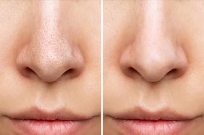 Фото до и после алмазного пилинга лица у косметолога