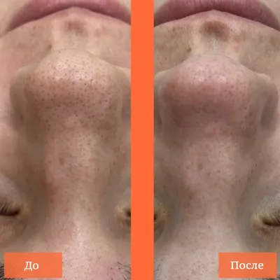 Как сузить поры на лице | Клиника эстетической медицины “Elevans”