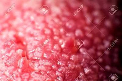 Микропапилломатоз половых губ, вульвы у женщин: причины и лечение, фото