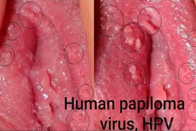 Вирус папилломы человека | Портал помощи пациентам