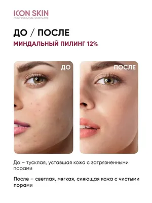 Пилинг для лица 12% кислотный миндальный ICON SKIN 10143783 купить за 756 ₽  в интернет-магазине Wildberries