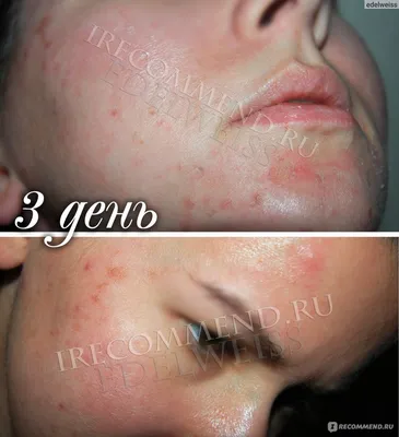 Купить МИНДАЛЬНЫЙ ПИЛИНГ 40% MANDELIC ACID PEEL Ставрополь от Герцина