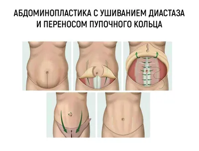 Абдоминопластика живота в клинике «ДОКТОРПЛАСТИК» | Цены на  абдоминопластику в Москве