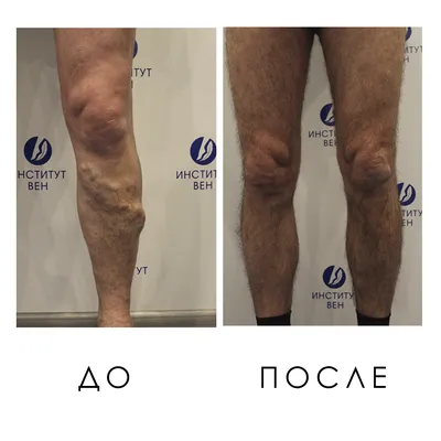 Минифлебэктомия - лечение варикоза ног лазером в Киеве и Харькове - клиника  флебологии «Институт Вен»