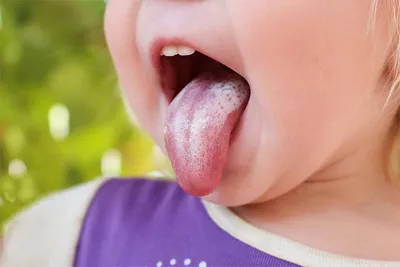 Лечение кандидоза полости рта у взрослых — препараты, местное лечение,  народные средства в статье Startsmile