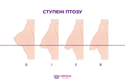 Рак груди :: ДНК-клиника