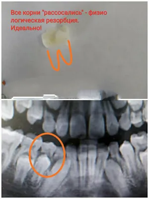 Есть ли корни у молочных зубов? | Пикабу