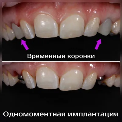 Коронки на молочные зубы