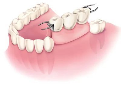 Мостовидные протезы в Минске │ Цена зубного моста