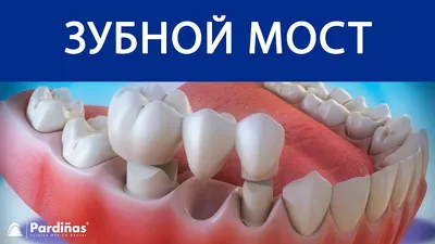 Зубной мост по цене от 3000 рублей в Краснодаре