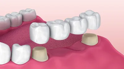 Выпал зубной мост – можно ли приклеить обратно самому