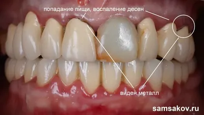 Зубной мост на имплантах — преимущества и недостатки метода